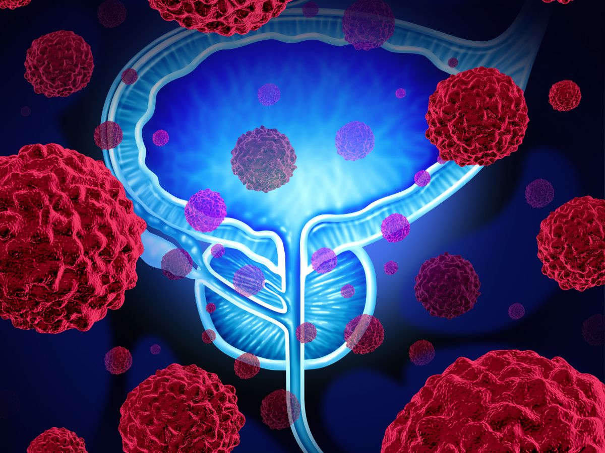 el cáncer de próstata puede extenderse a otros órganos