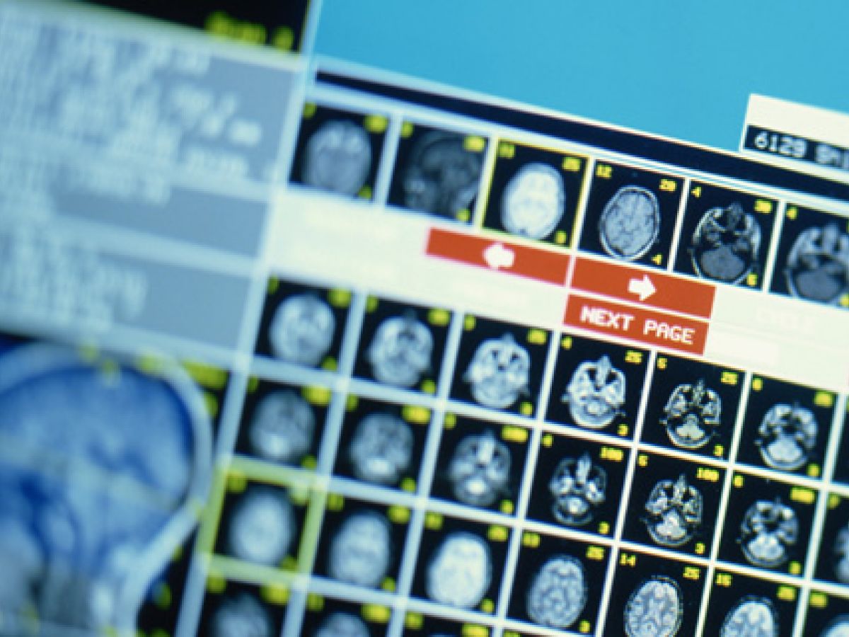 ¿Modifica el ‘bullying’ el cerebro?