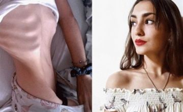 Mostró el impacto de la anorexia en su cuerpo y su historia se volvió viral