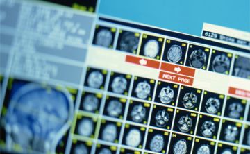¿Modifica el ‘bullying’ el cerebro?