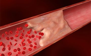 Un equipo de investigadores ha descubierto nuevos mecanismos de calcificación vascular