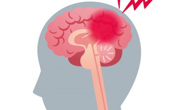 Conoce los riesgos de sufrir un derrame cerebral