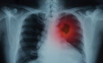 Un tratamiento contra el cáncer de pulmón reduce el riesgo de muerte un 51%