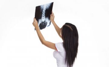 La osteoporosis: cuando los huesos son débiles y quebradizos