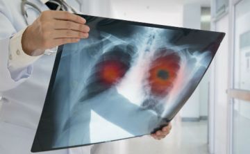 Descubren el motivo por el que la inmunoterapia es eficaz en algunos tipos de cáncer de pulmón